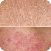 Skin damage